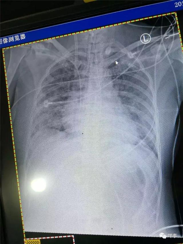 流感下的广州夫妇：一场流感花了几十万，人救回来了