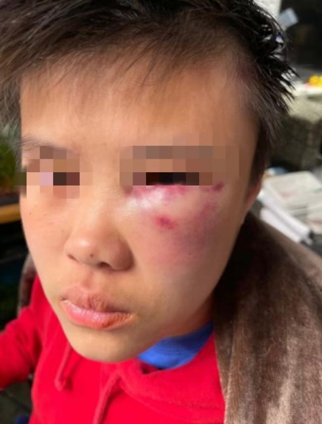 震惊！列治文14岁华裔女生，在学校被同学殴打致昏迷！下手太狠了…
