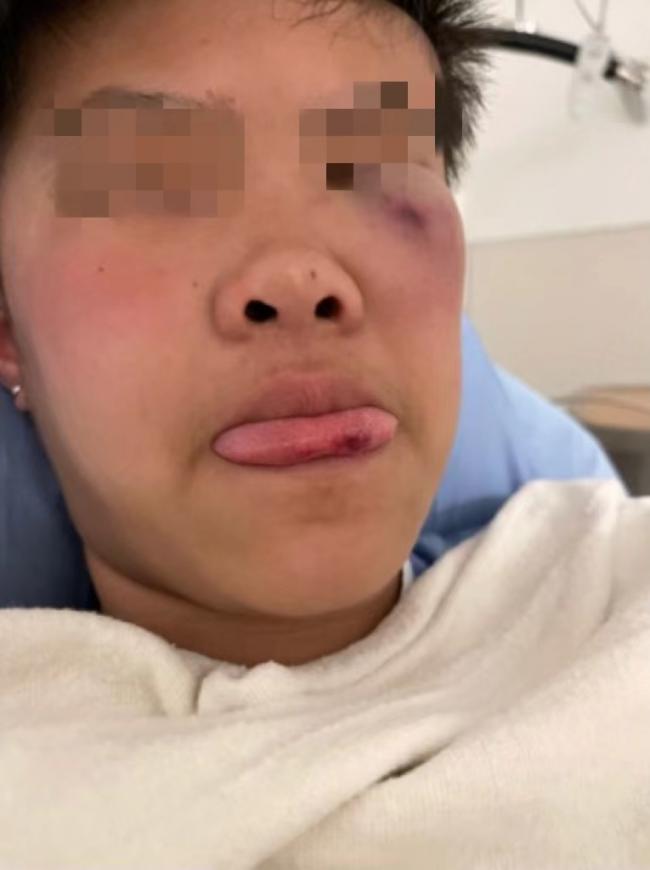 震惊！列治文14岁华裔女生，在学校被同学殴打致昏迷！下手太狠了…