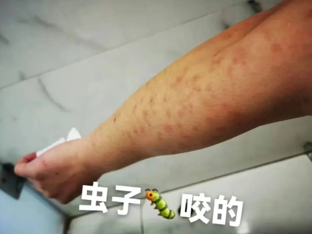 李梓硕被蚊子咬的胳膊/受访者供图