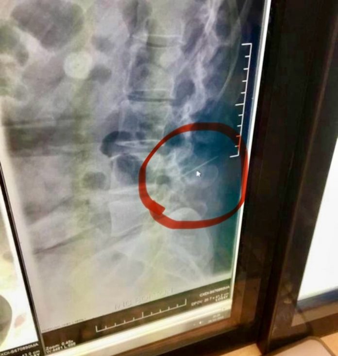 x-ray-of-giovanna-ippolito-side.jpg 图片
