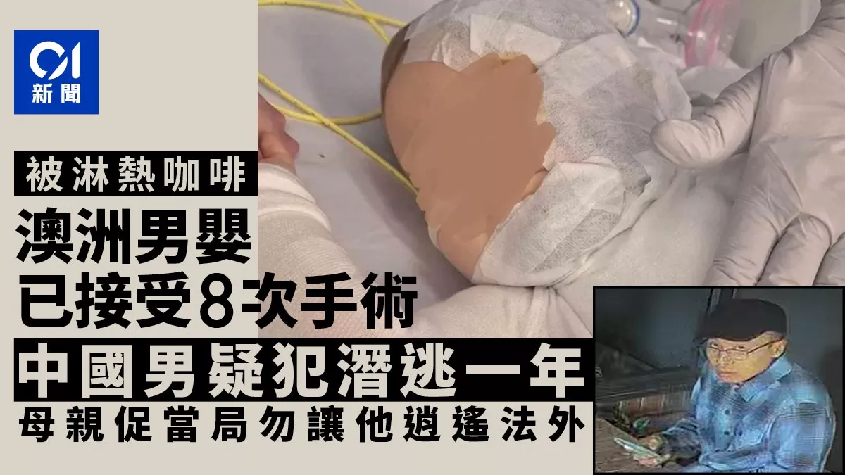 澳男婴被中国男严重烫伤1周年：已8次手术 母亲促…